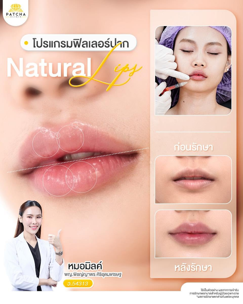 รีวิวฉีดฟิลเลอร์ปากที่ Patcha Clinic