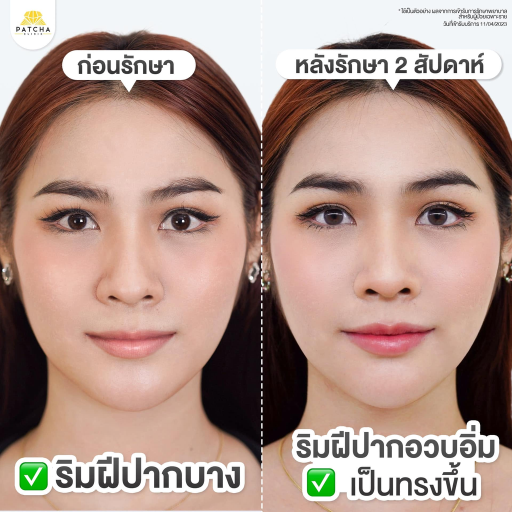 รีวิวฉีดฟิลเลอร์ปากที่ Patcha Clinic