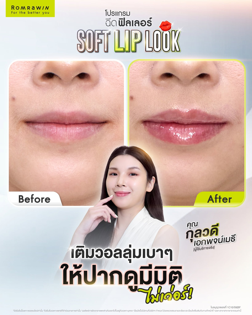 รีวิวฉีดฟิลเลอร์ปากที่ Romrawin Clinic