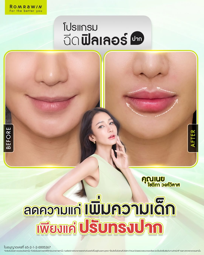 รีวิวฉีดฟิลเลอร์ปากที่ Romrawin Clinic
