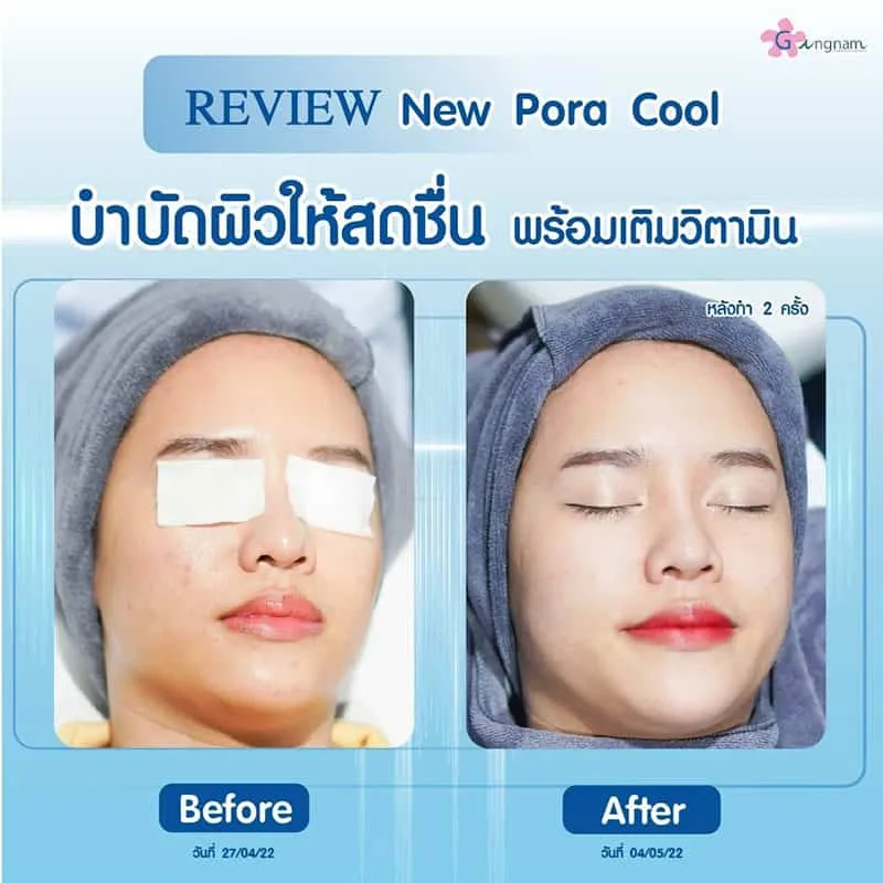 รีวิวรักษาสิวที่ Gangnam Clinic