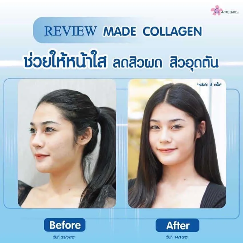 รีวิวรักษาสิวที่ Gangnam Clinic