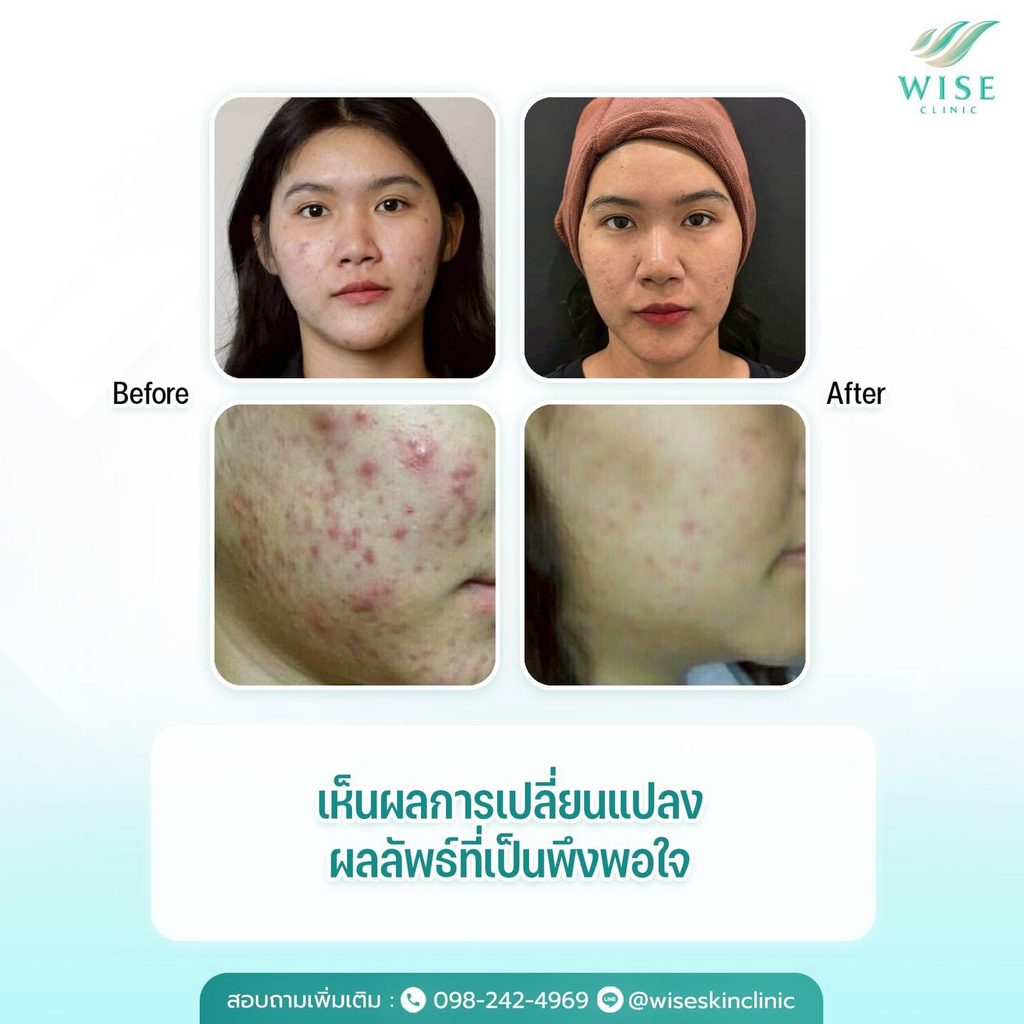 รีวิวรักษาสิวที่ Wise Skin Clinic