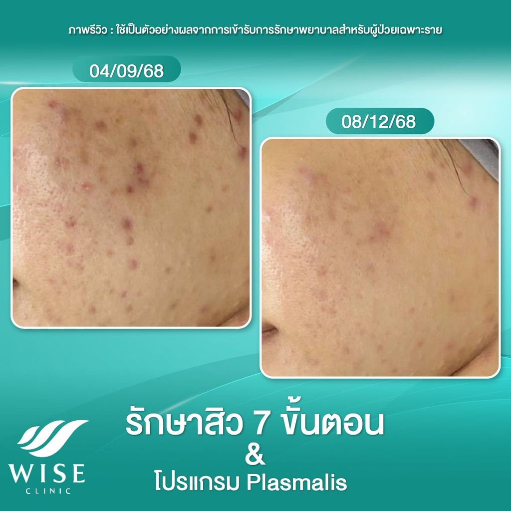 รีวิวรักษาสิวที่ Wise Skin Clinic