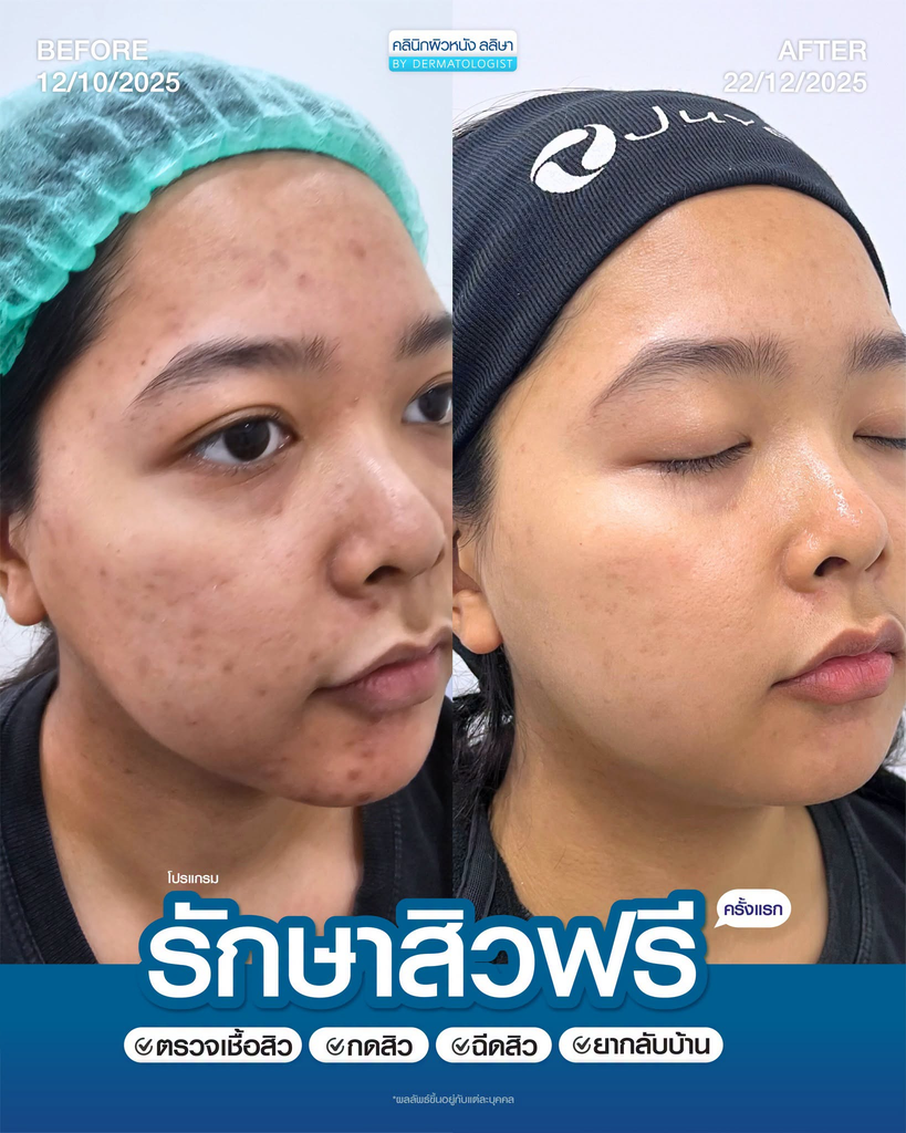 รีวิวรักษาสิวที่ LALIZA Clinic
