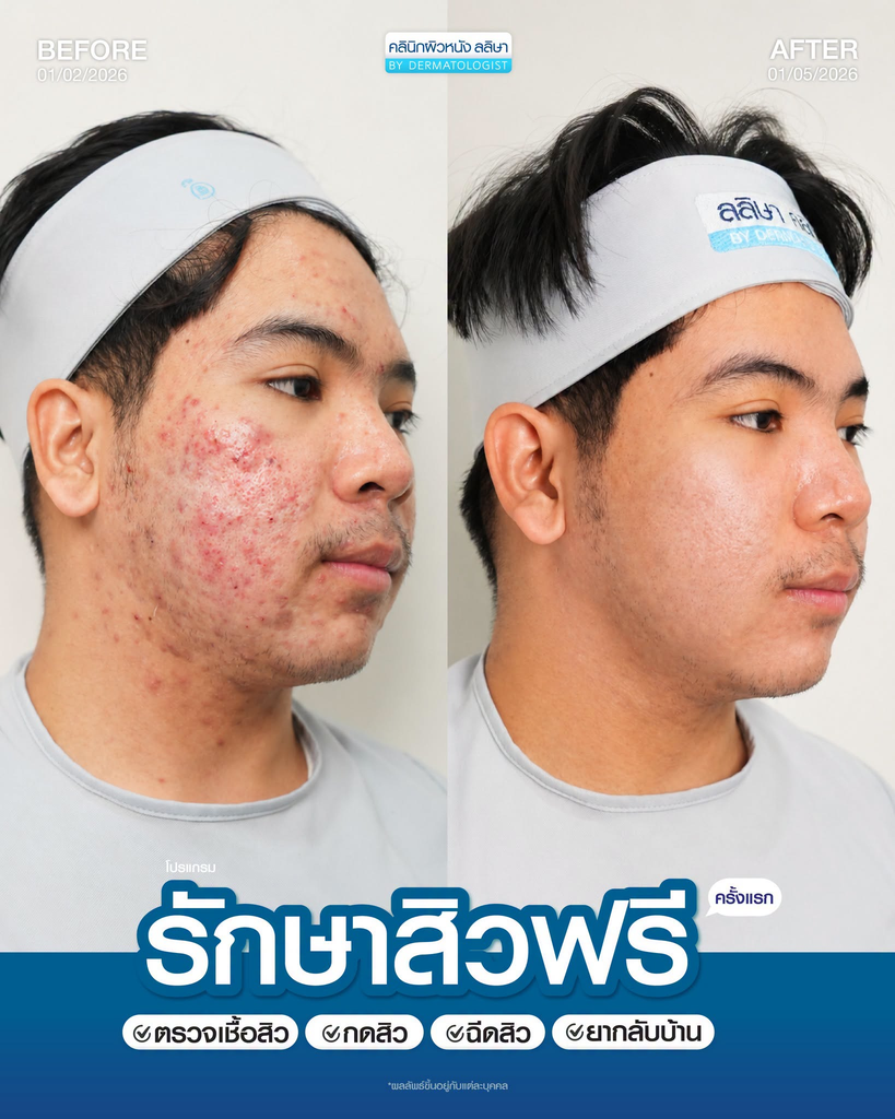 รีวิวรักษาสิวที่ LALIZA Clinic
