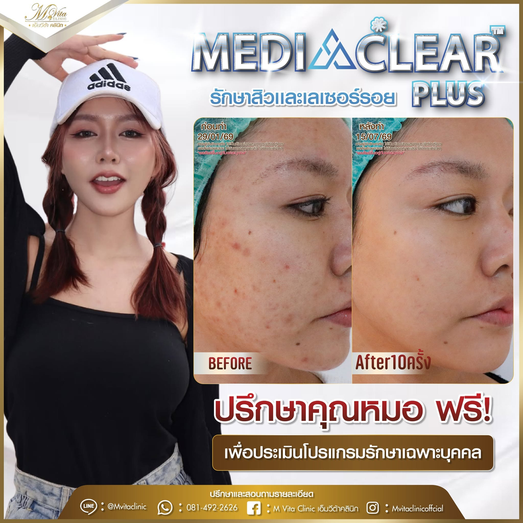รีวิวรักษาสิวที่ M Vita Clinic