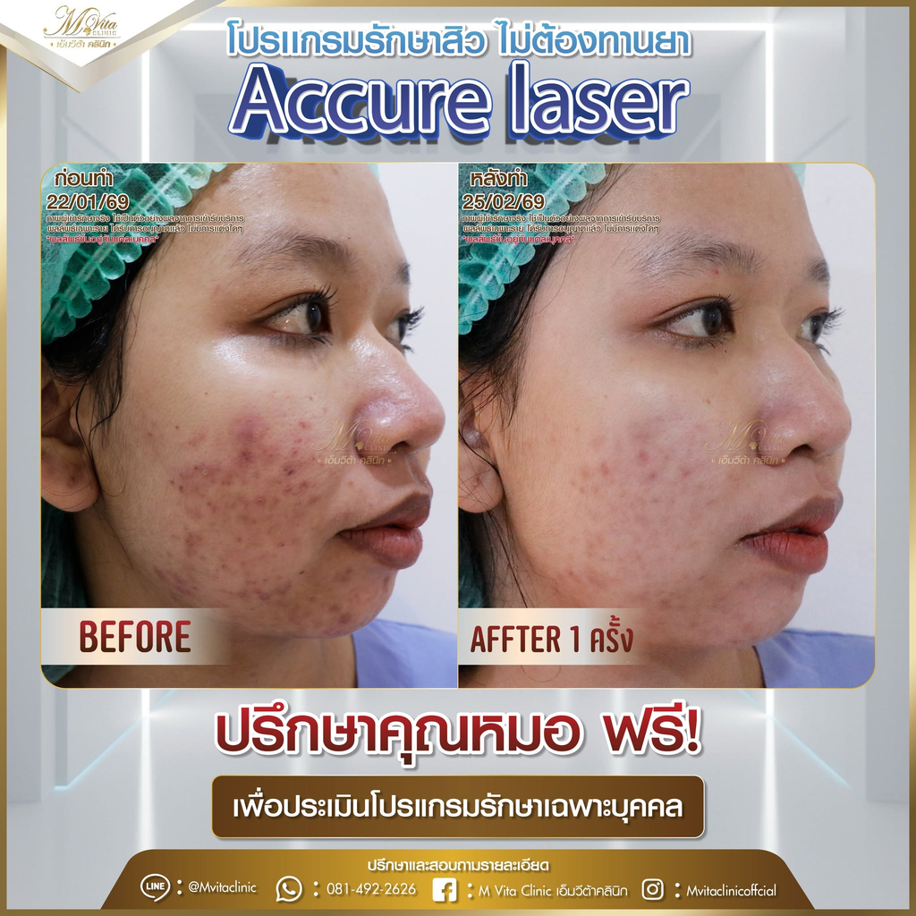 รีวิวรักษาสิวที่ M Vita Clinic