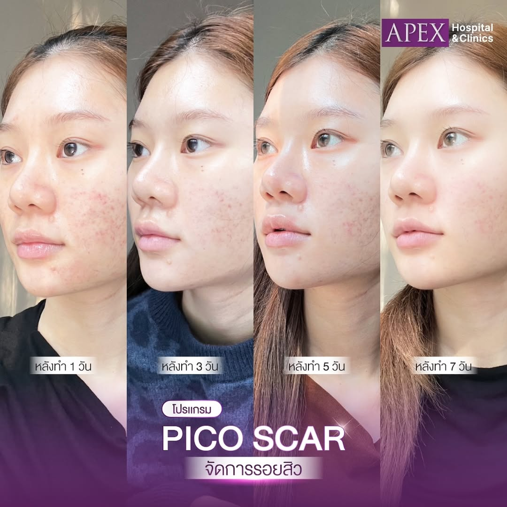 รีวิวรักษาสิวที่ Apex Profound Beauty