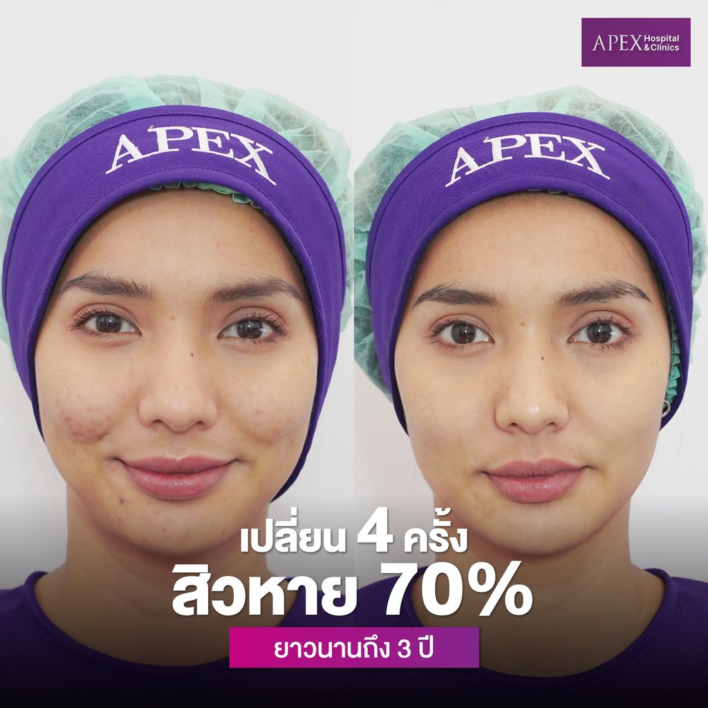 รีวิวรักษาสิวที่ Apex Profound Beauty