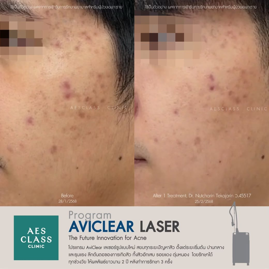 รีวิวรักษาสิวที่ AES CLASS Clinic