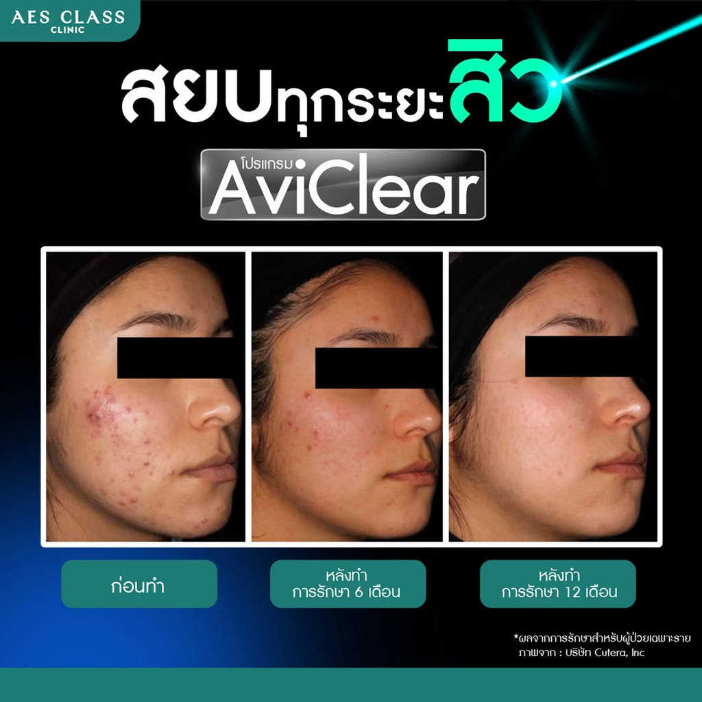 รีวิวรักษาสิวที่ AES CLASS Clinic
