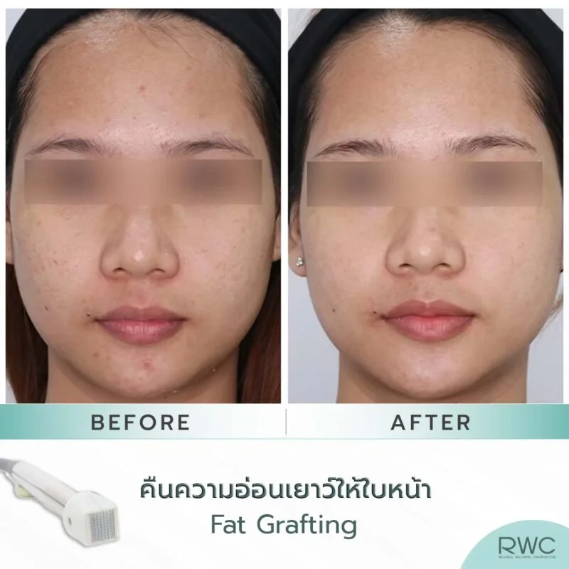 รีวิวรักษาสิวที่ RWC Clinic