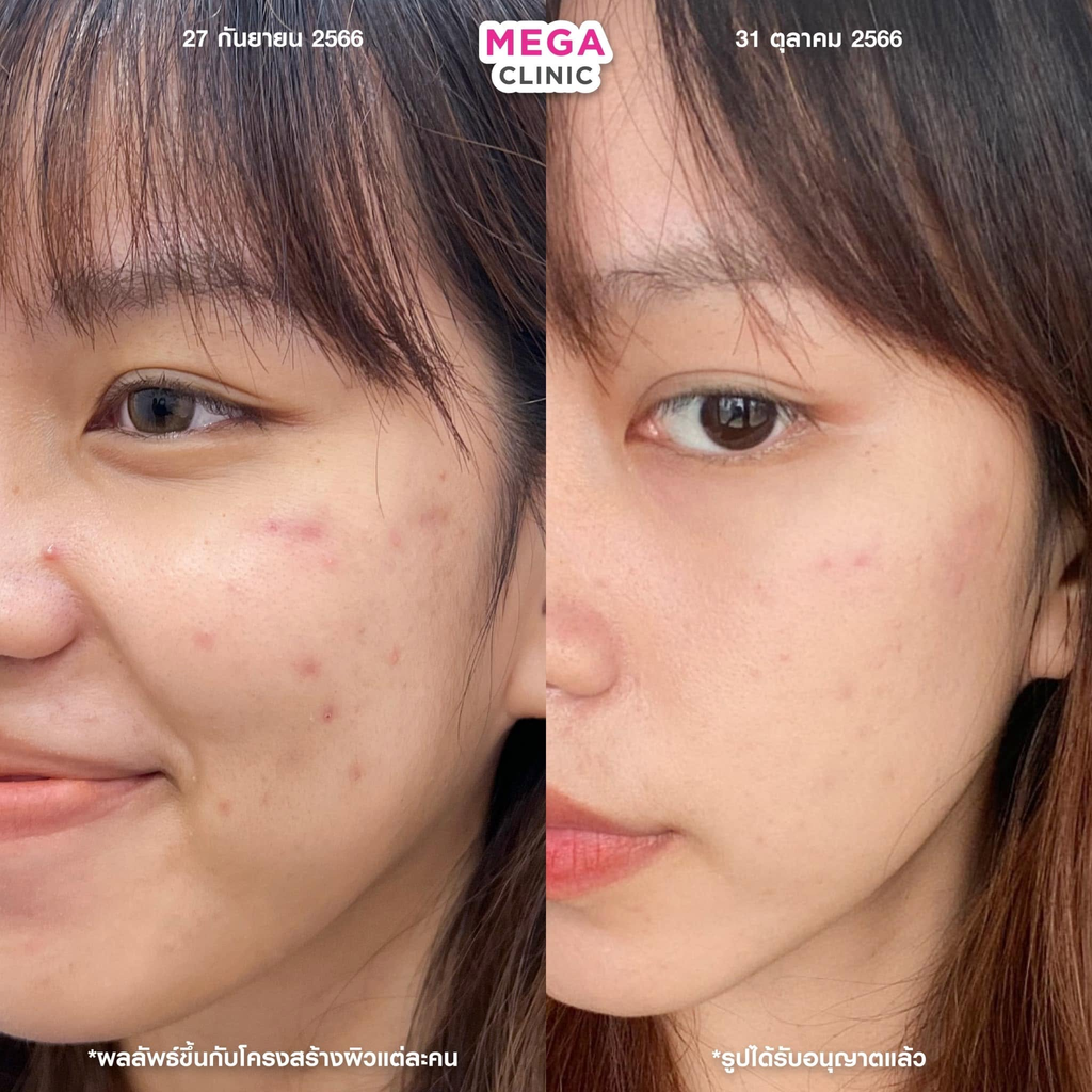 รีวิวรักษาสิวที่ Mega Clinic