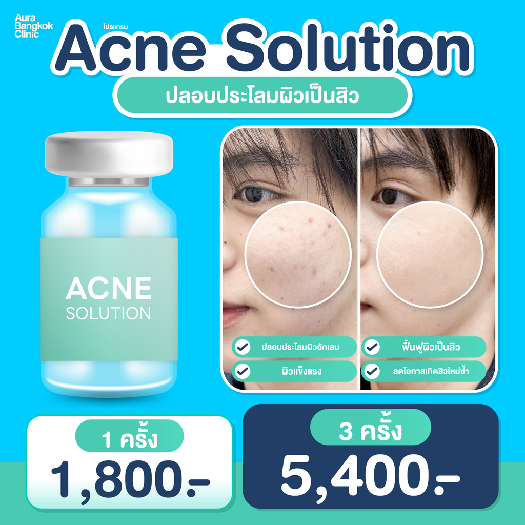รีวิวรักษาสิวที่ Aura Bangkok Clinic