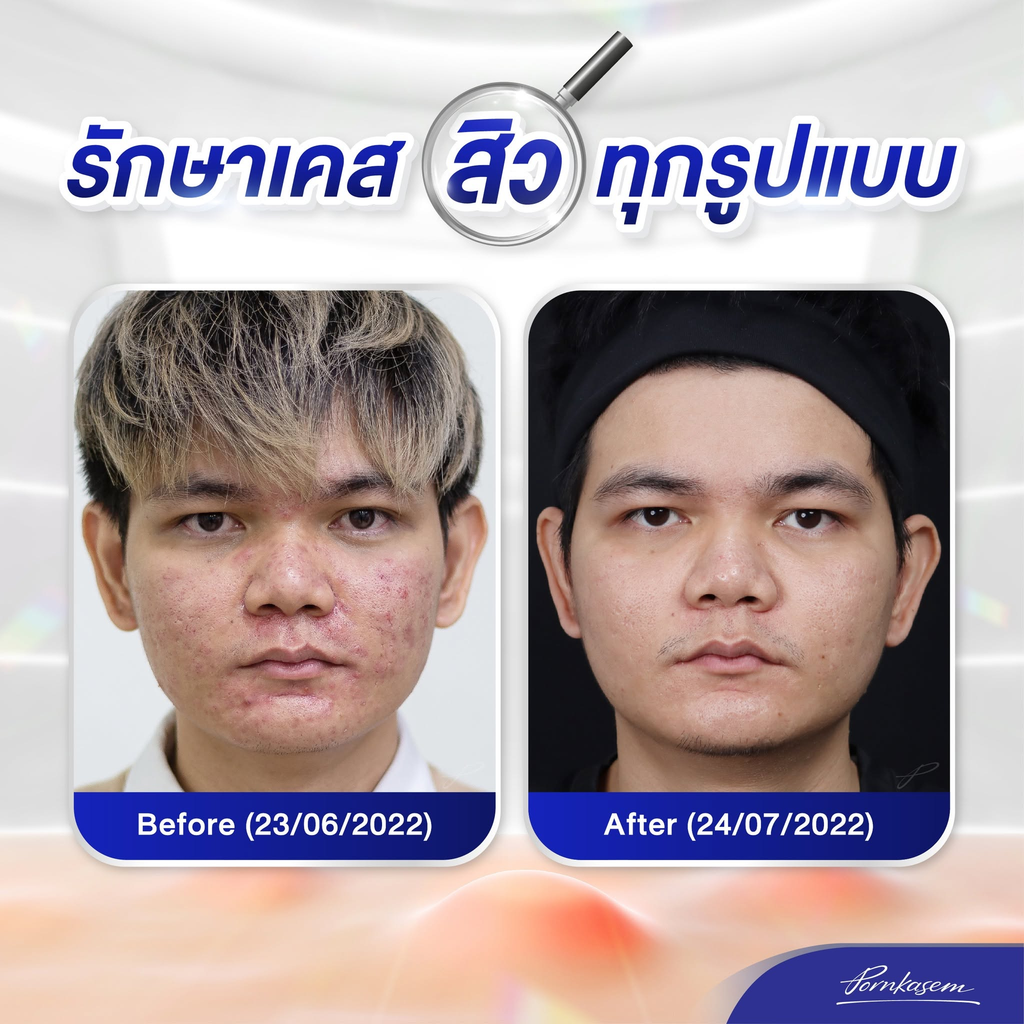 รีวิวรักษาสิวที่ Pornkasem Clinic
