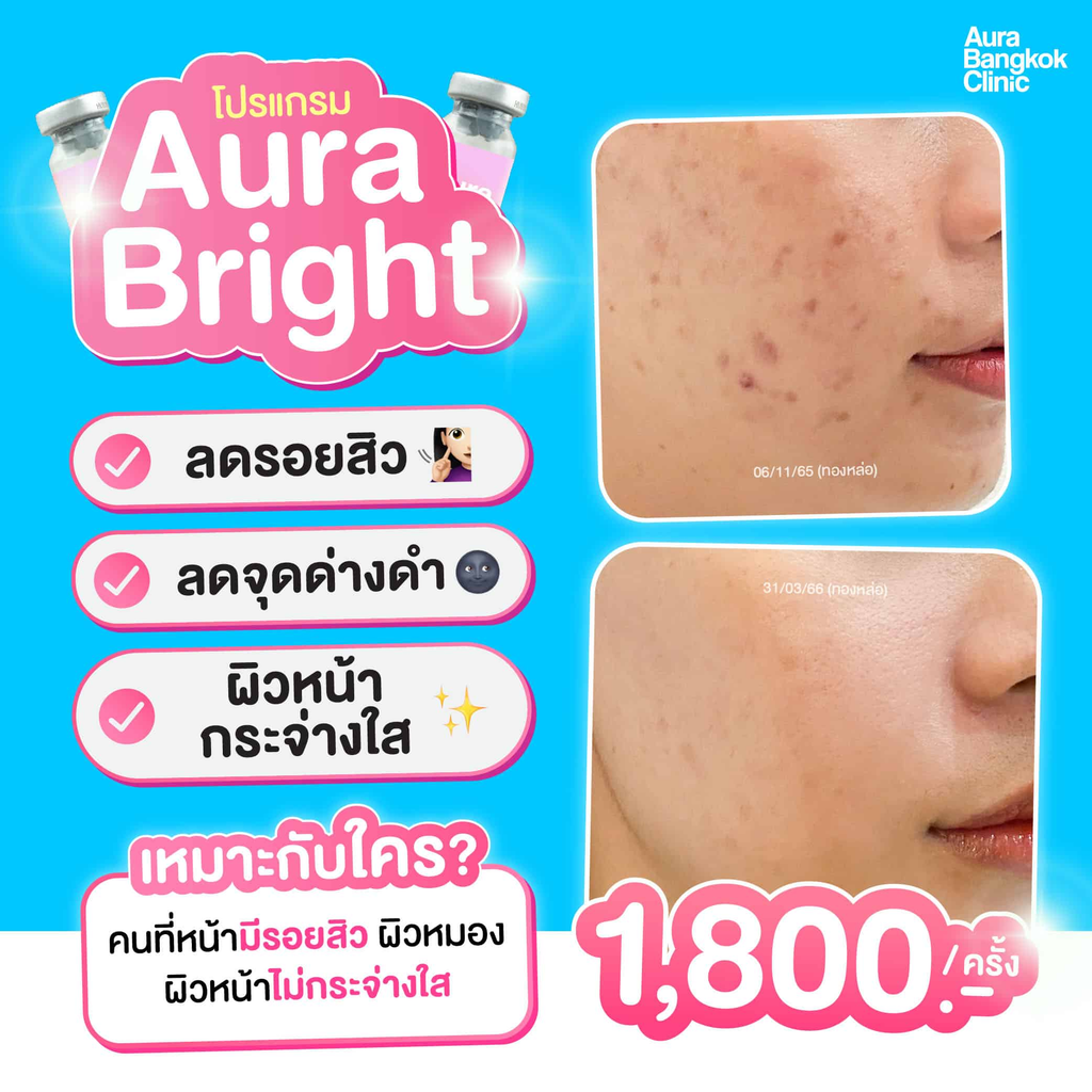 รีวิวรักษาสิวที่ Aura Bangkok Clinic