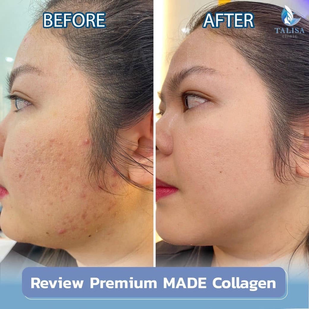 รีวิวรักษาสิวที่ TALISA Clinic