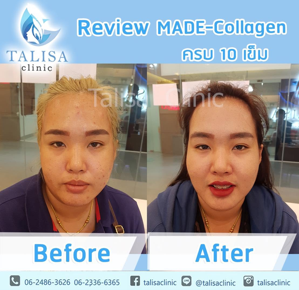 รีวิวรักษาสิวที่ TALISA Clinic