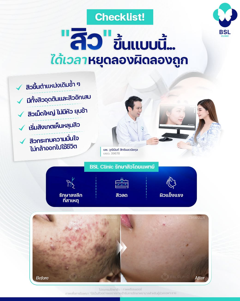 รีวิวรักษาสิวที่ BSL Clinic