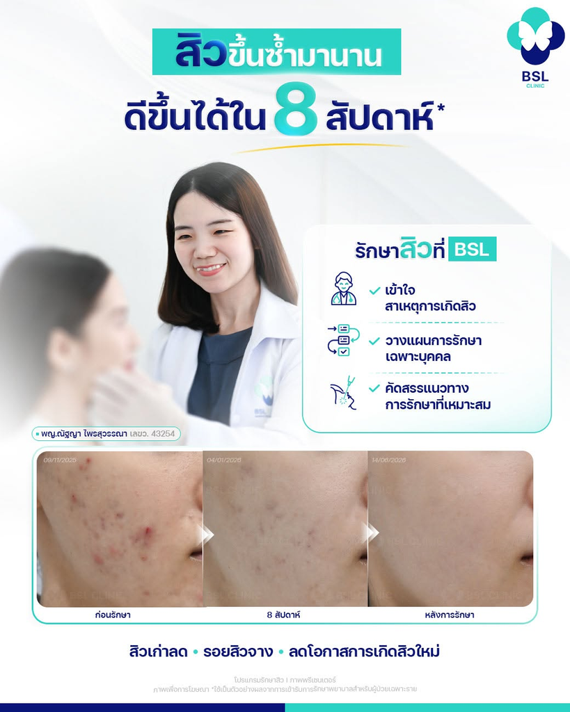 รีวิวรักษาสิวที่ BSL Clinic