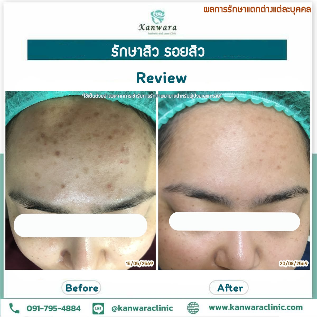 รีวิวรักษาสิวที่ Kanwara Clinic