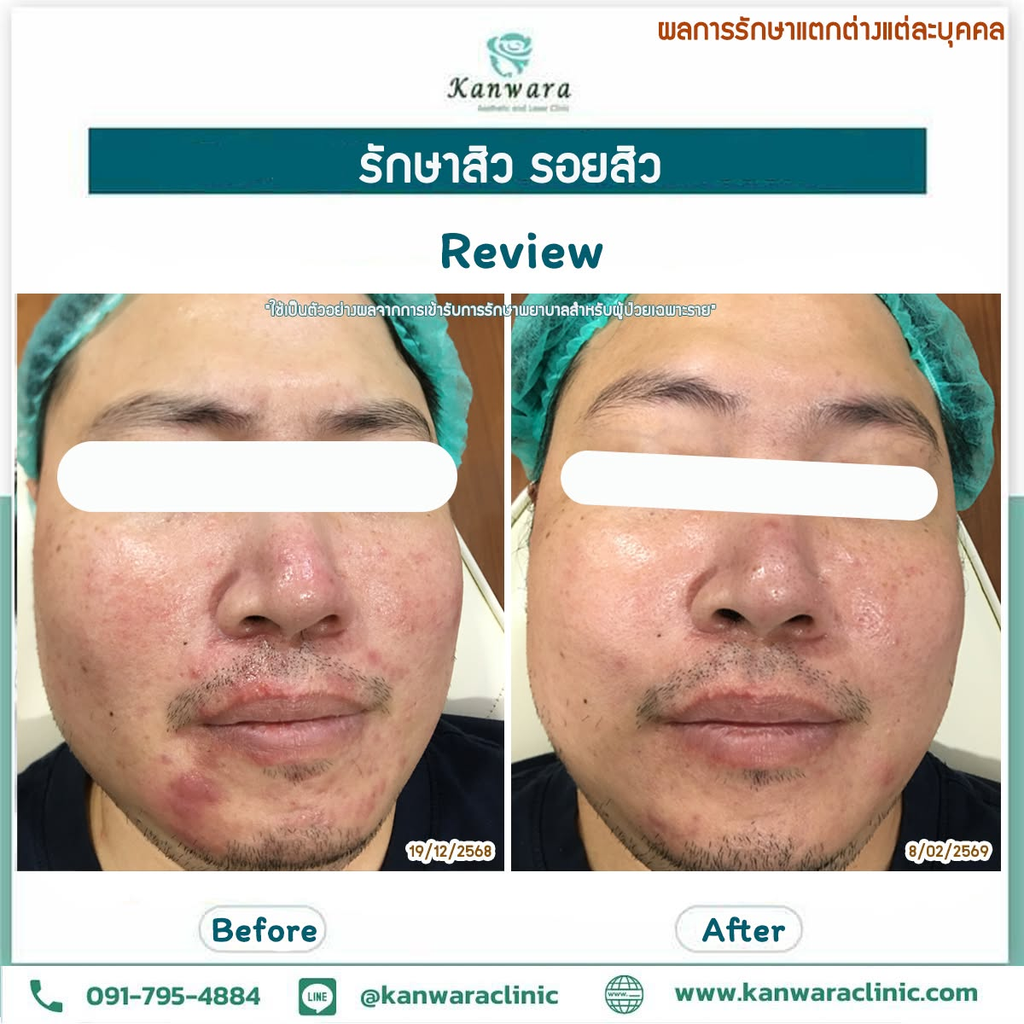 รีวิวรักษาสิวที่ Kanwara Clinic