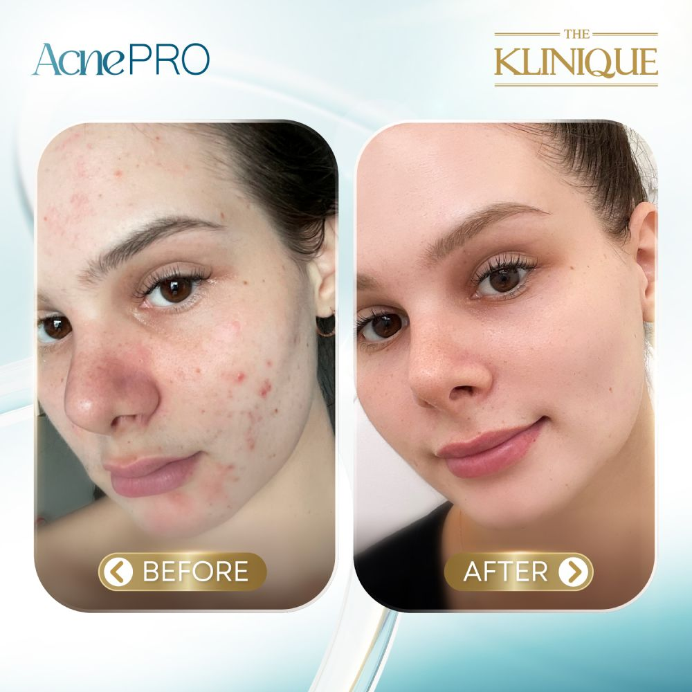 รีวิวรักษาสิวที่ THE KLINIQUE Clinic