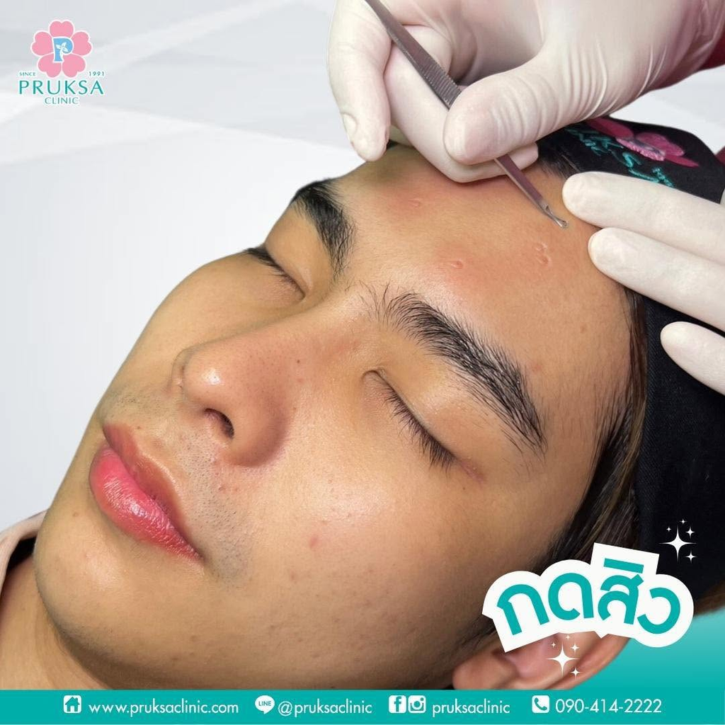 รีวิวรักษาสิวที่ PRUKSA Clinic