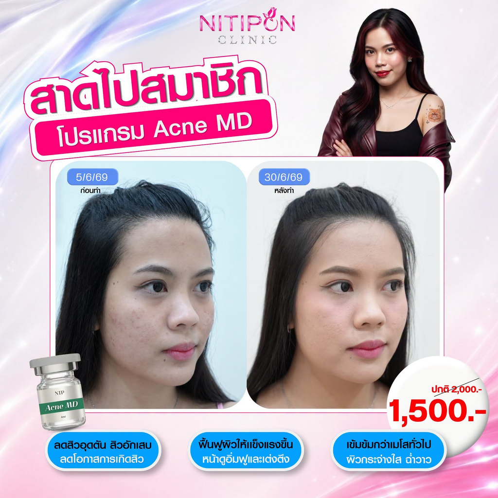 รีวิวรักษาสิวที่ นิติพลคลินิก