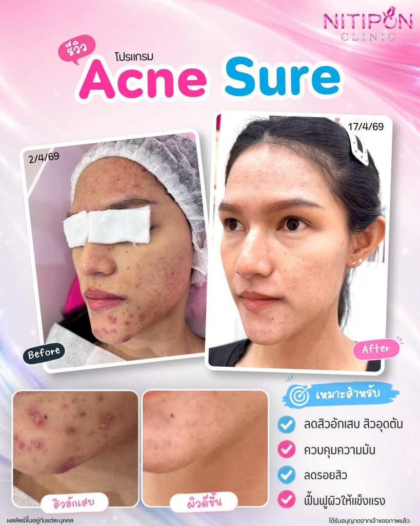 รีวิวรักษาสิวที่ นิติพลคลินิก