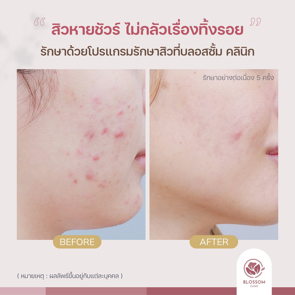 รีวิวรักษาสิวที่ Blossom Clinic