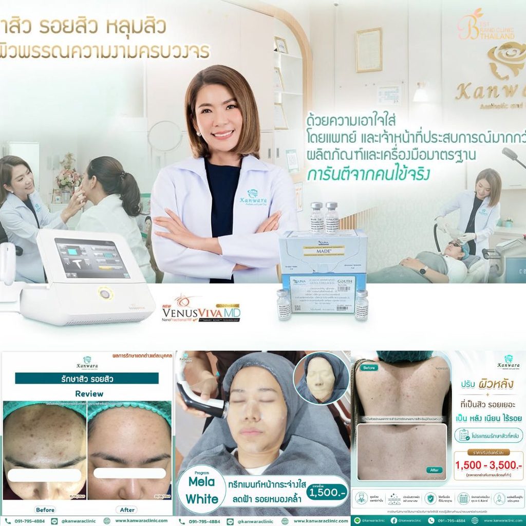 รักษาสิวที่ Kanwara Clinic