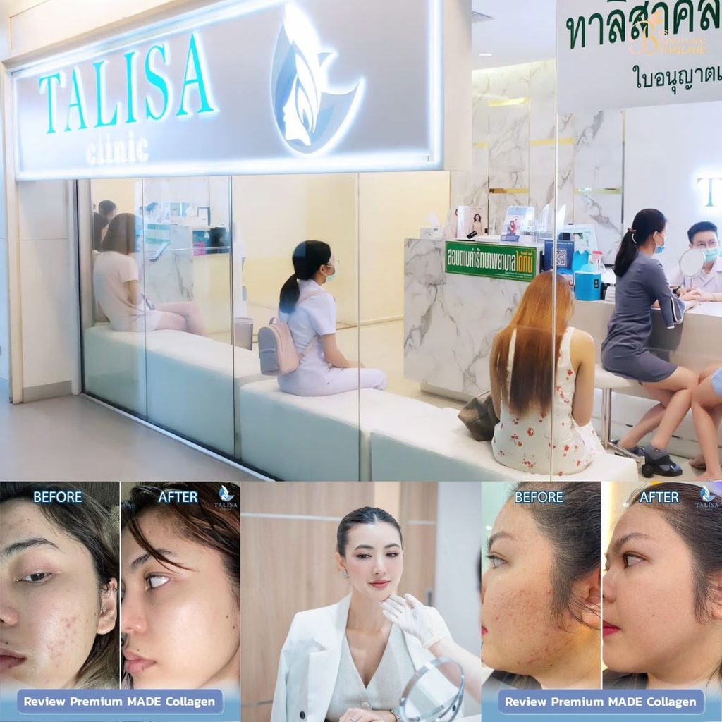 รักษาสิวที่ TALISA Clinic